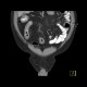 Chronic inflammatory changes of aboral ileum and cecum, fatty infiltration of bowel wall: CT - Computed tomography